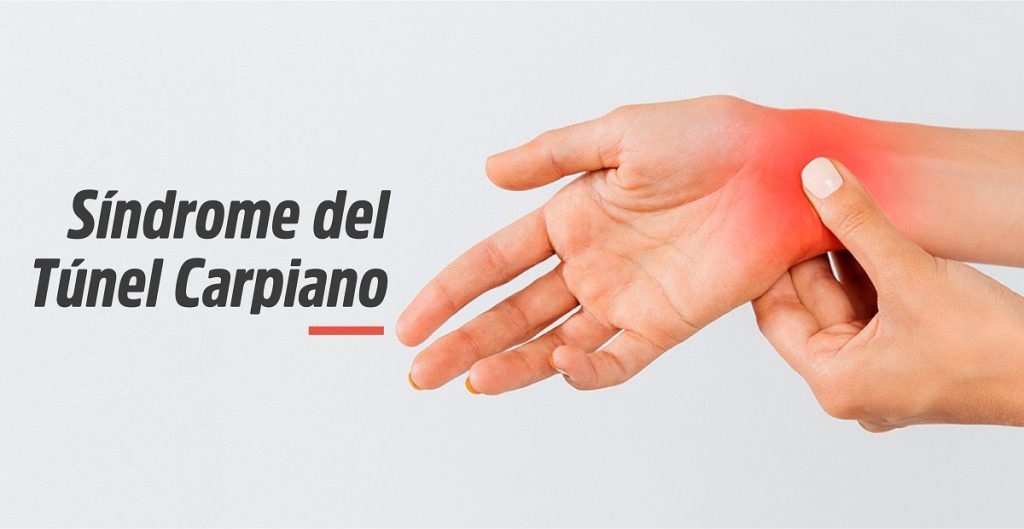 SINDROME DEL TUNEL DEL CARPO